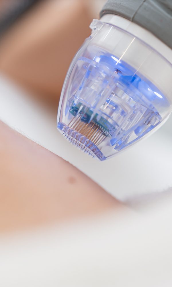 The Benefits of Regular Microneedling and Chemical Skin Peels for Healthier, More Radiant Skin